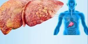 ماذا نعرف عن مرض الكبد الدهني وأسبابه؟.. تقارير طبية تُجيب
