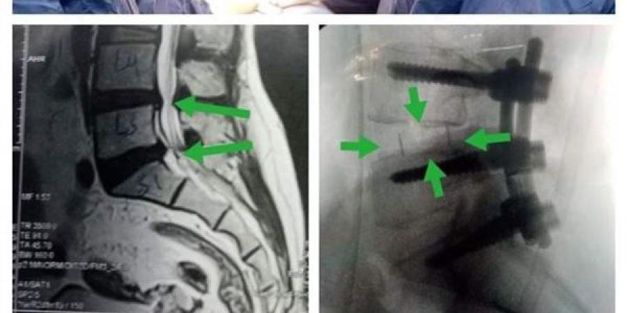 فريق جراحى بكفر شكر التخصصى ينقذ مريضة من الإصابة بالشلل بعد تركيب قفص كربوني