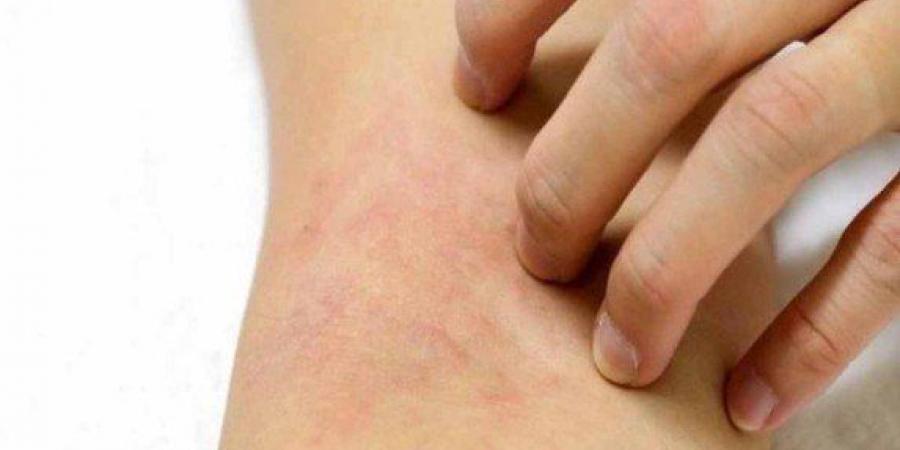 فريق بحثي أمريكي يتوصل لعلاج يحسن حالة مرضى سرطان الجلد المتقدم