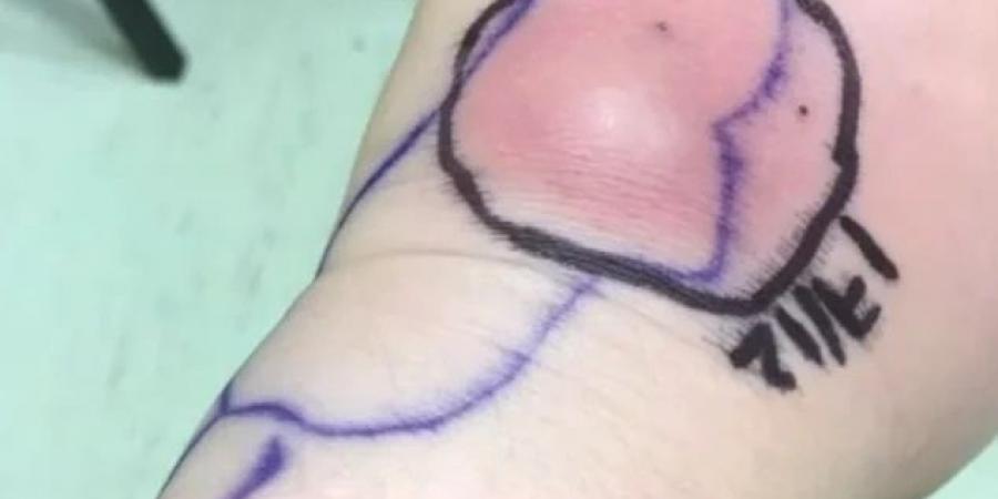 إبرة ملوّثة تحوّل حياة شابة بريطانية إلى جحيم دائم