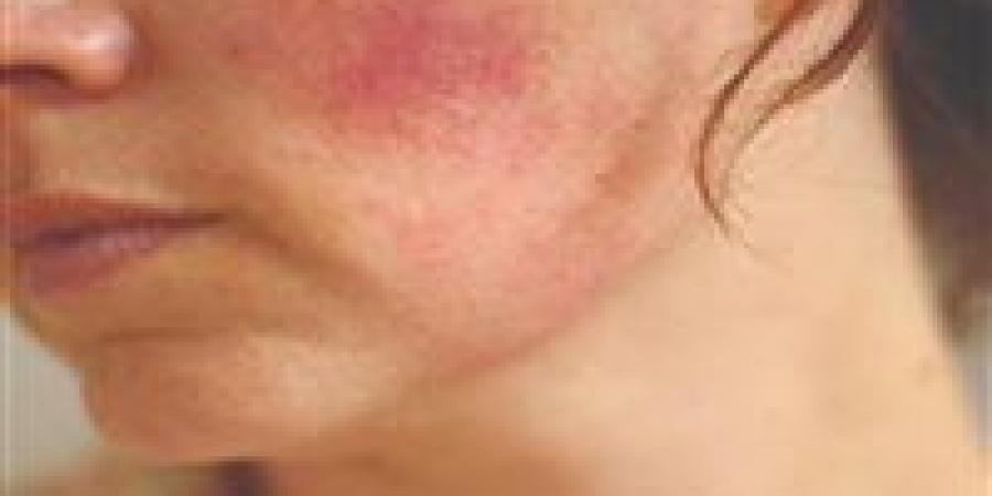 فصل الصيف.. الطرق الفعالة للتعامل مع التهابات البشرة بعد التعرض لأشعة الشمس